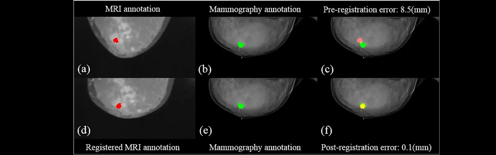 How Is MR Mammography Of Breast Useful?
